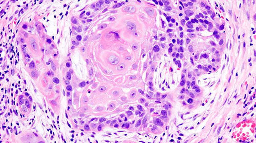Histologisches Präparat eines Plattenepithelkarzinoms der Mundhöhle.