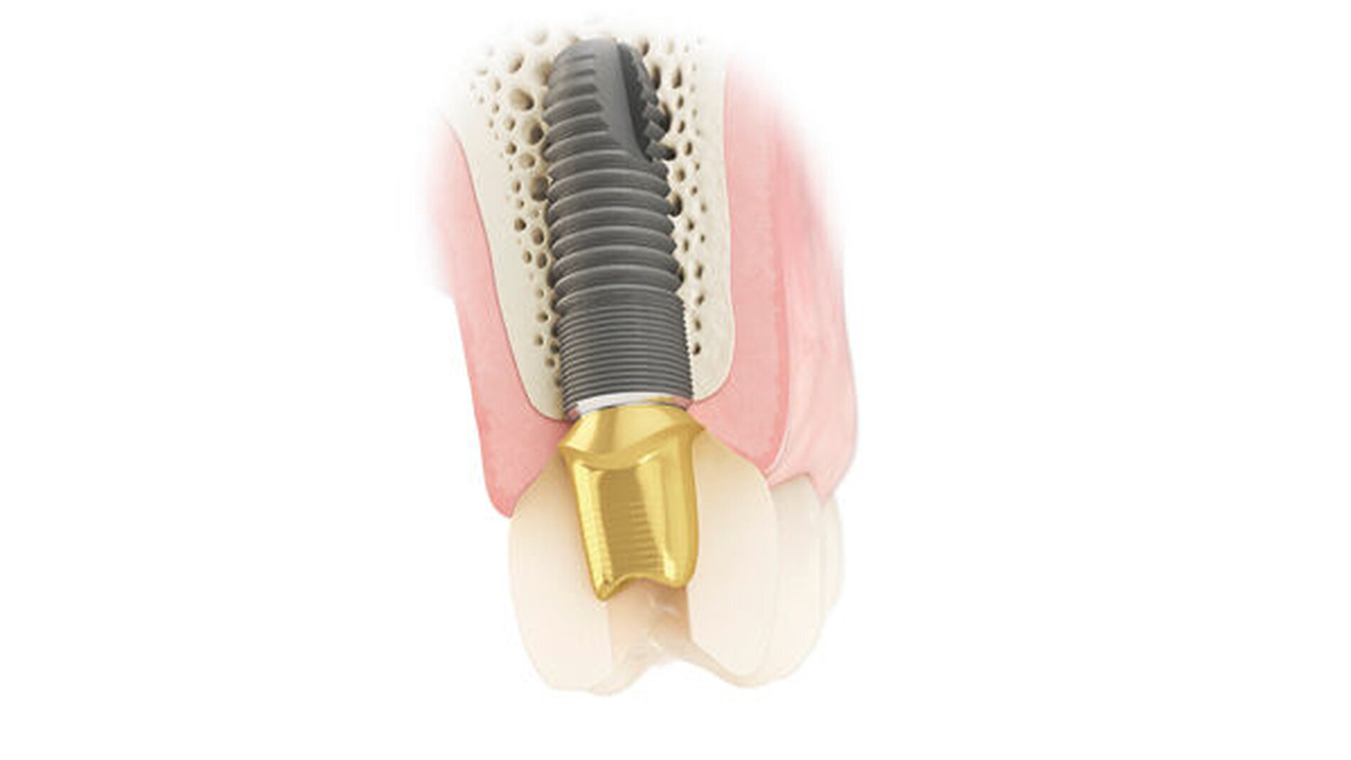 Dentsply Sirona Implants Atlantis CustomBase
