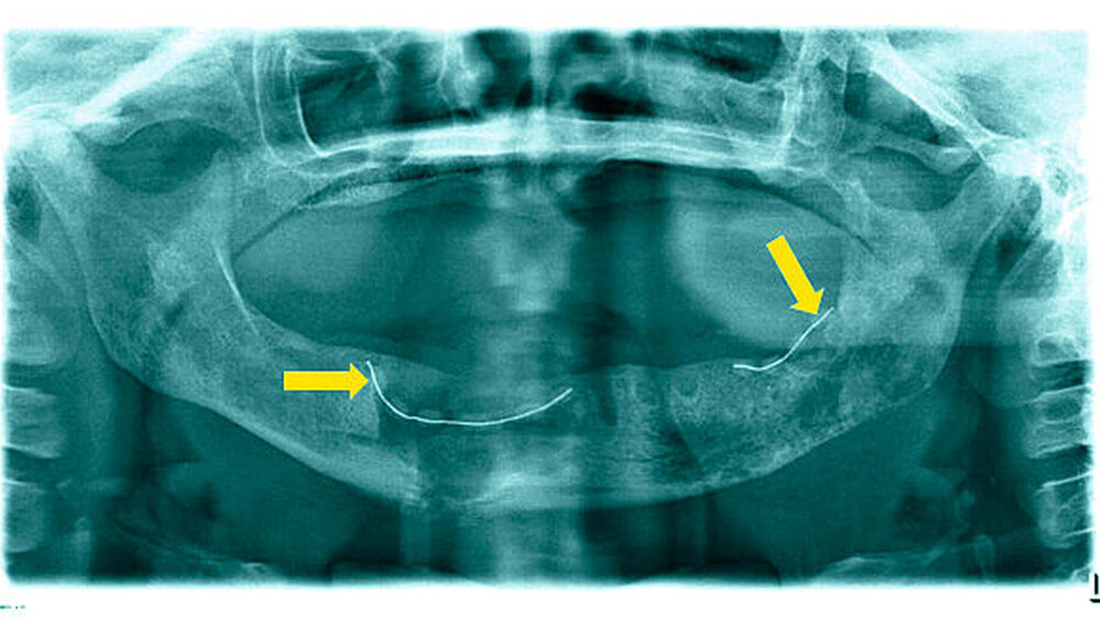 Abbildung 3: Postoperative Situation nach Entfernung aller verbliebenen Zähne sowie Dekortikation, Sequestrotomie, modellierende Osteotomie und Einbringung zweier Gentamicin-PMMA-Ketten (gelbe Pfeile) im Orthopantomogramm. |