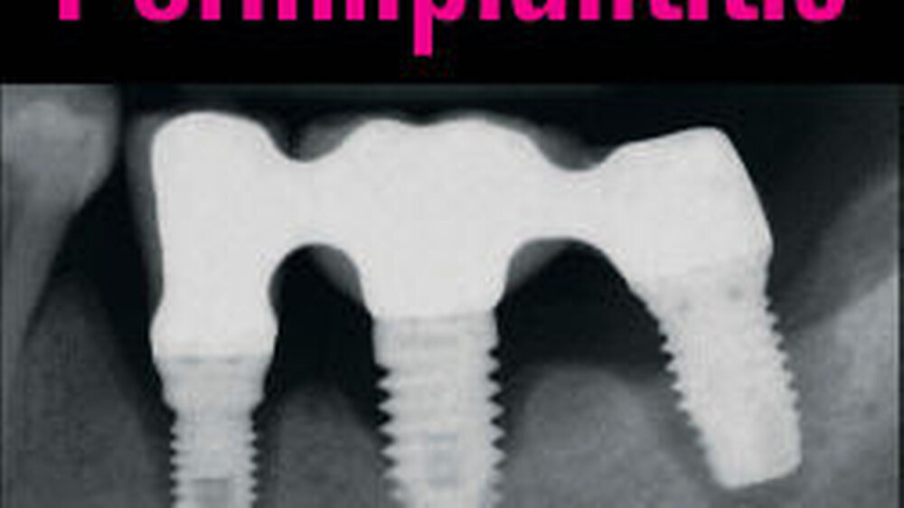Stefan Renvert, Jean-Louis Giovannoli: Periimplantitis. 168 EUR | Stefan Renvert, Jean-Louis Giovannoli: Periimplantitis. 168 EUR |