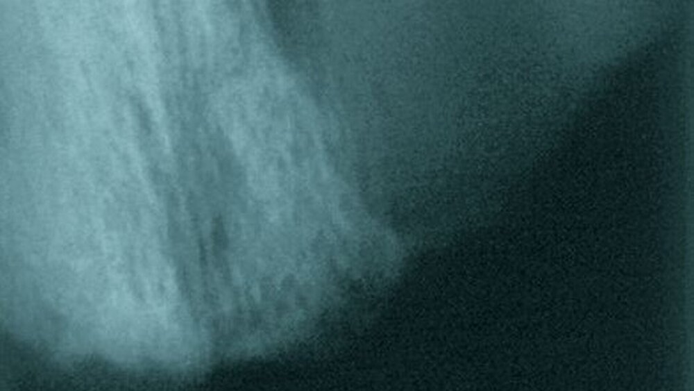 Abbildung 2a und 2b: Zahnfilm-Röntgen regio 21 bis 23 mit deutlich sichtbarer Osteolyse |