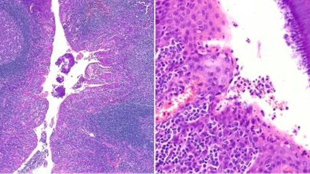 Abbildung 3: a: Die Tonsilla palatina weist eine Oberfläche aus unverhorntem Plattenepithel auf, die insbesondere im Bereich der Krypten von zahlreichen Lymphozyten und Granulozyten durch wandert wird. Darunter befinden sich zahlreiche, meist aktivierte Lymphfollikel. (5x-Vergrößerung); b: Die Krypten sind häufig durch Actinomyces besiedelt, die Drusen bilden; dem angrenzenden Plattenepithel aufgelagert sind mehrere neutrophile Granulozyten sichtbar. (40x-Vergrößerung) |