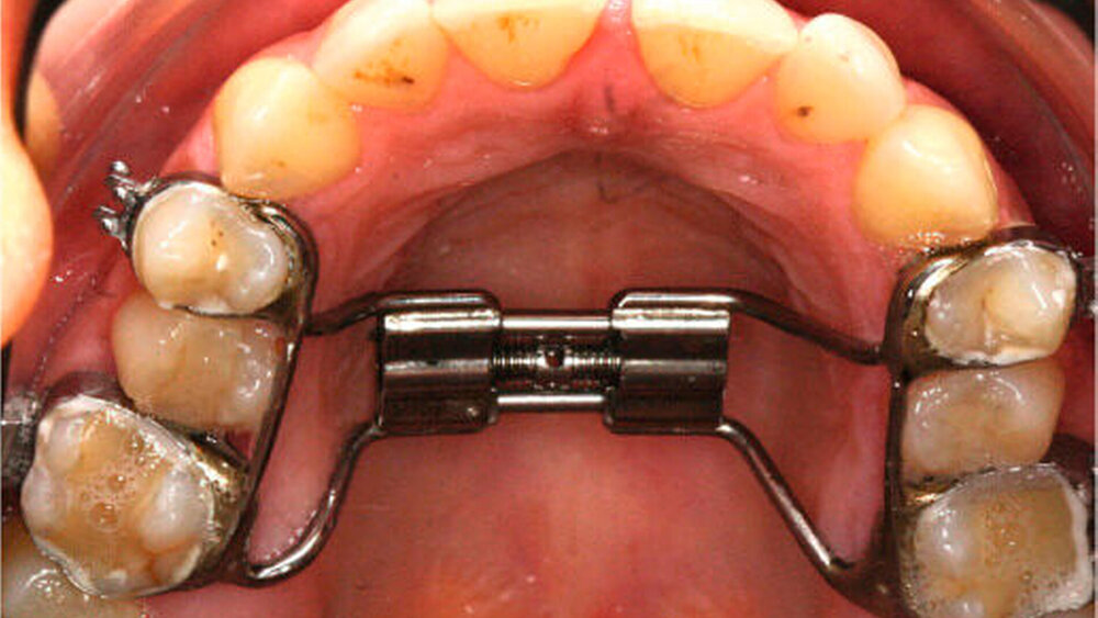 Abbildung 3: a) Zustand nach transversaler Erweiterung mittels GNE: Die GNE verblieb zur Retention in situ. |