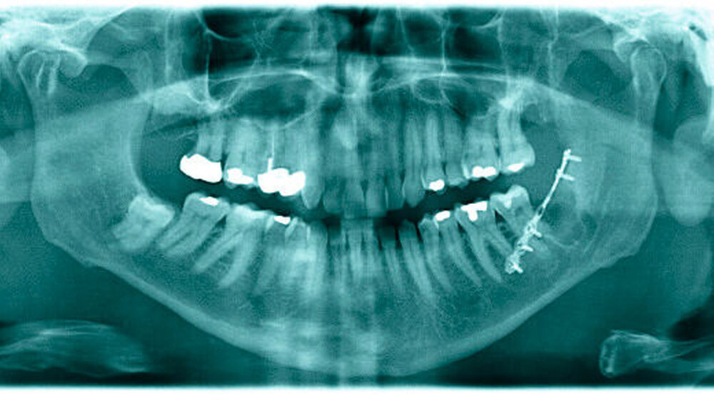 Abbildung 1: Postoperative Panoramaschichtaufnahme: Die analoge, präoperativ angefertigte Aufnahme zeigte aufgrund der geringeren Qualität keinerlei Anzeichen einer Fraktur. Auf der qualitativ deutlich besseren, allerdings postoperativ angefertigten Pan Abbildung 1: Postoperative Panoramaschichtaufnahme: Die analoge, präoperativ angefertigte Aufnahme zeigte aufgrund der geringeren Qualität keinerlei Anzeichen einer Fraktur. Auf der qualitativ deutlich besseren, allerdings postoperativ angefertigten Panoramaschichtaufnahme gibt es keinen sicheren Anhalt für eine Fraktur, nachdem der Patient beim Kauen das Krachen vernahm. |