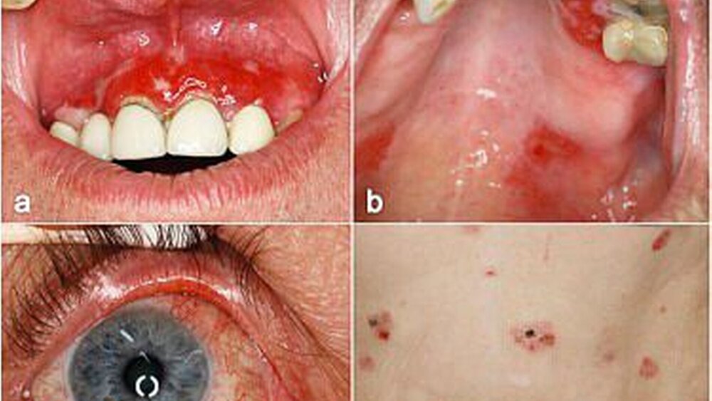 Abbildung 5: Schleimhautpemphigoid: a: ausgeprägte desquamative Gingivitis, b: fibrinbelegte Erosionen am Gaumen, c: konjunktivale Injektion, d: an der Haut zeigen sich einzelne Erosionen. |