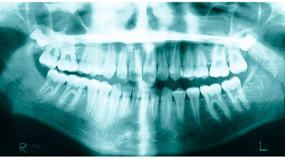 Abbildung 1 e: Bei weiter voranschreitendem Abbau des rechten Kondylus, zeigt das FRS jetzt drei Jahre später eine verstärkte Rücklage des Unterkiefers und einen offenen Biss. |