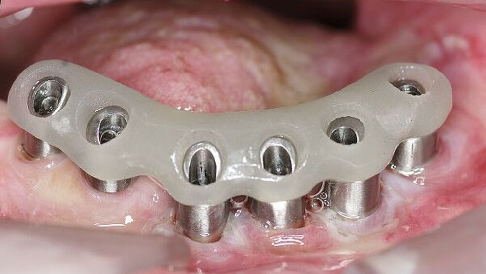 Abbildung 9: Anprobe der zu Primärkronen gefrästen Abutments: Die Einbringhilfe dient zusätzlich zur Kontrolle einer korrekten Implantatabformung. |