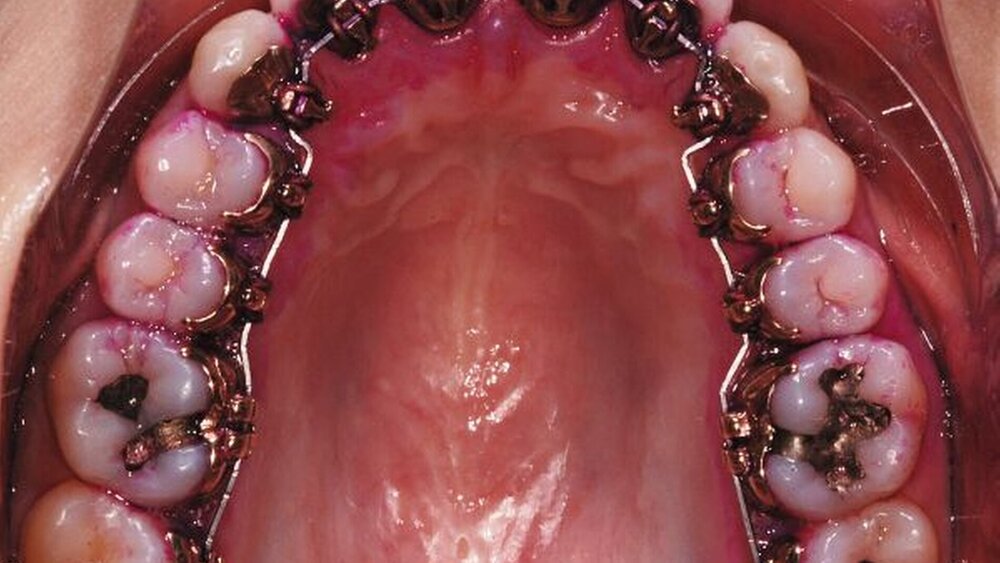 Plaqueakkumulation (detektiert mit Färbemethode) an vestibulärer Apparatur sowie rechts bei lingualer Apparatur. |