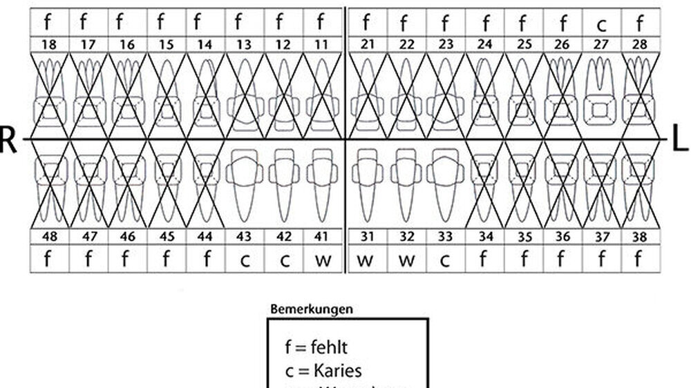 Das Gebiss des unbekannten Toten bestand nur noch aus drei kariösen Zähnen und drei Wurzelresten.