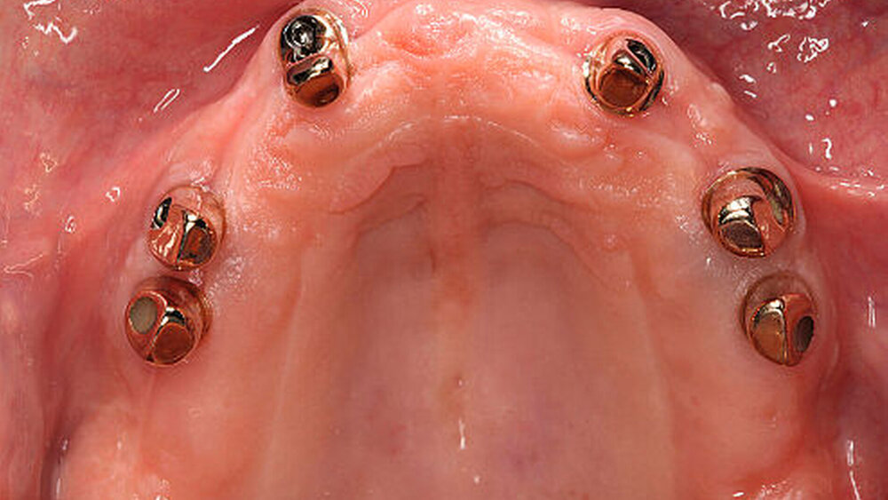 Abbildung 8 und 9: Im Oberkiefer wurden sechs Implantate mit Teleskopen versorgt. Hier wurde das Konzept des „Passive-Fit“ mithilfe der Galvanoteleskope realisiert. |