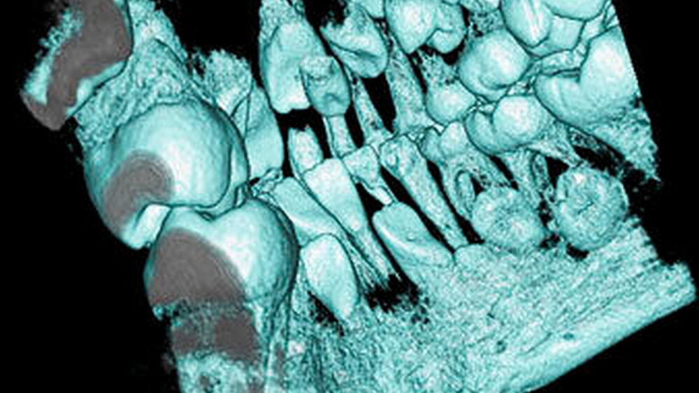 Abbildung 3b: 3-dimensionale Bildrekonstruktion, Ansicht von oral |