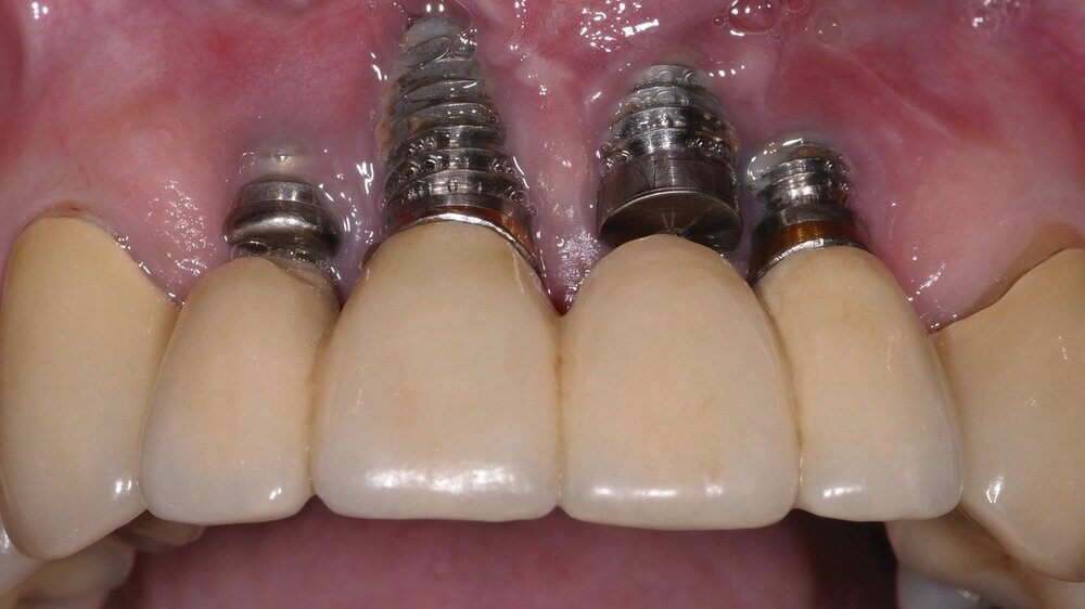 Periimplantitis