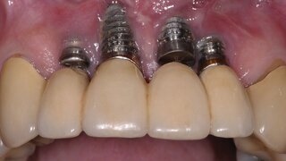 Periimplantitis