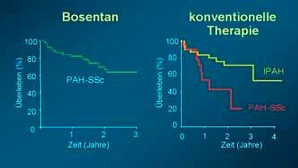 Prognose von Patienten mit arterieller pulmonaler Hypertonie und Sklerodermie (PAH-SSC) unter verschiedener Medikation im Vergleich zur Prognose von Patienten mit idiopathischer PAH (IPAH). Quelle: Denton et al. 2003; Kawut et al. 2003