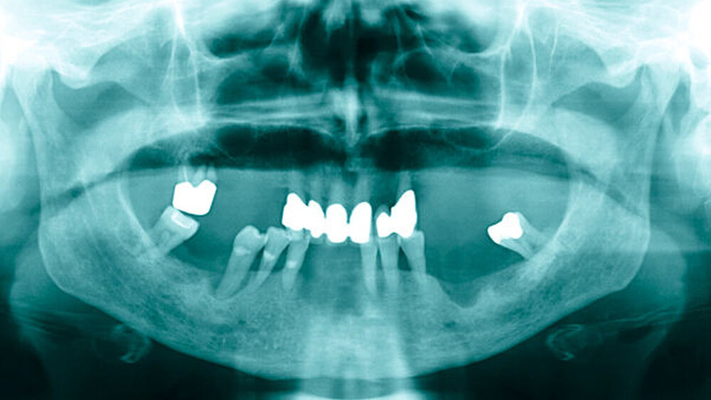 Abbildung 3: Panoramaschichtaufnahme mit prothetisch und konservierend unvollständig versorgtem Restgebiss: In der Unterkieferfront von Region 32 bis 42 ist eine unscharf begrenzte Osteolyse des Alveolarkamms sichtbar, im Vergleich zur deutlich schärferen Osteolyse im Bereich des stark parodontal geschädigten Zahns 45. |