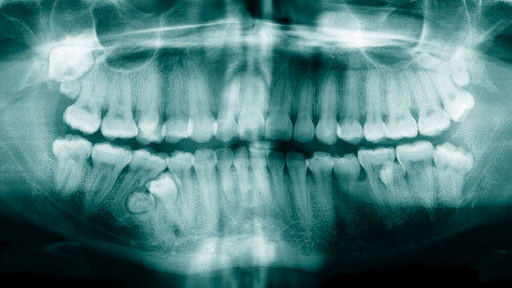 Abbildung 4: Multiple überzählige Zähne im Ober- und Unterkiefer bei einem knapp 21-jährigen Patienten. Im Oberkiefer finden sich Distomolaren beidseits, im Unterkiefer überzählige Prämolaren beidseits. |