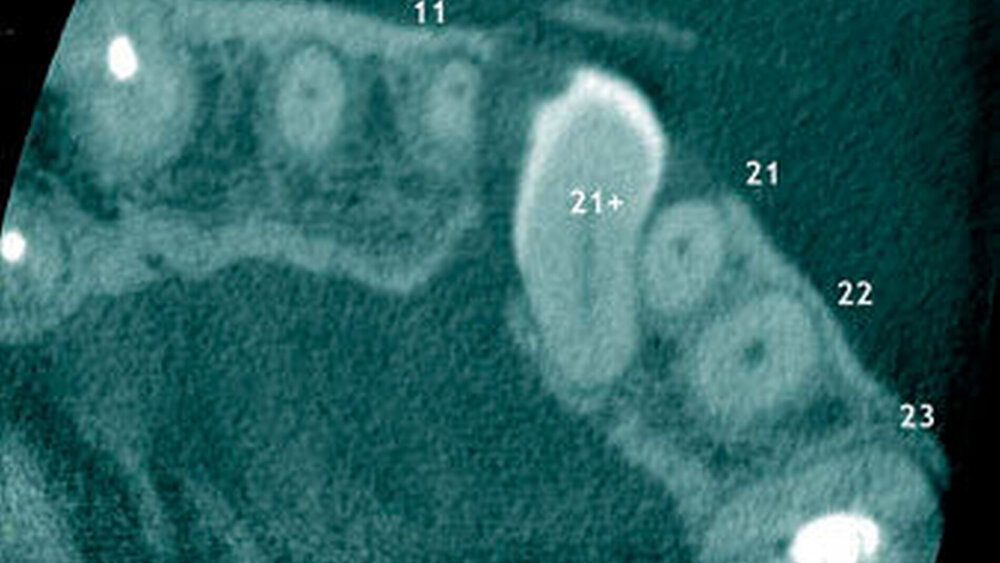 Abbildung 19: Überzähliger Zahn im Oberkieferfrontbereich (21+) mit zystischer Erweiterung des Zahnsäckchens und radiologisch erkennbarer Resorption der mesialen Wurzel von 11 bei einem 46-jährigen Patienten (c: axialer Schnitt). |