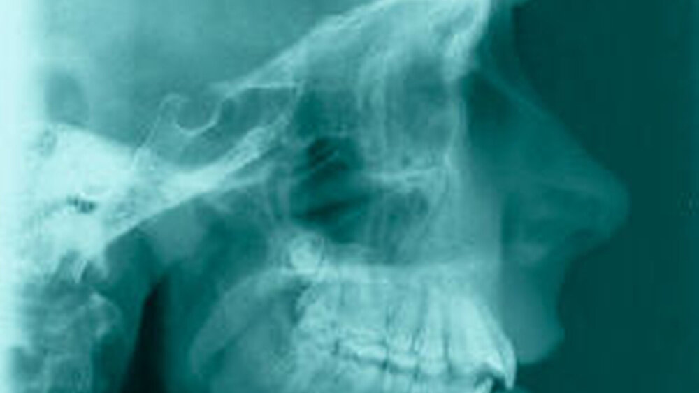 Abbildung 1 f: Bei weiter voranschreitendem Abbau des rechten Kondylus, zeigt das FRS jetzt drei Jahre später eine verstärkte Rücklage des Unterkiefers und einen offenen Biss. |