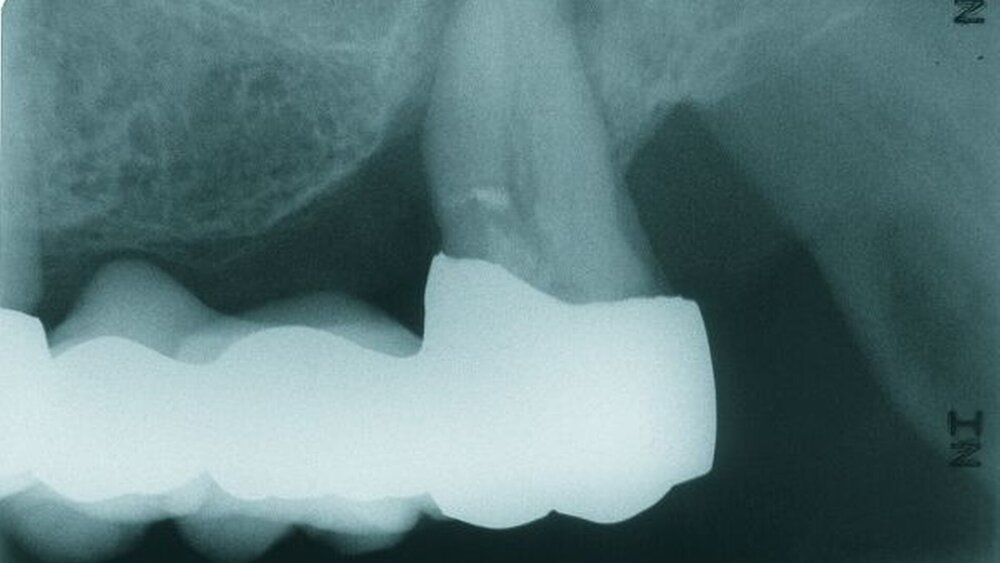 Abbildungen 3a, 3b: Zahnfilmaufnahmen der regiones 17 und 27 vom 29.04.2008. |