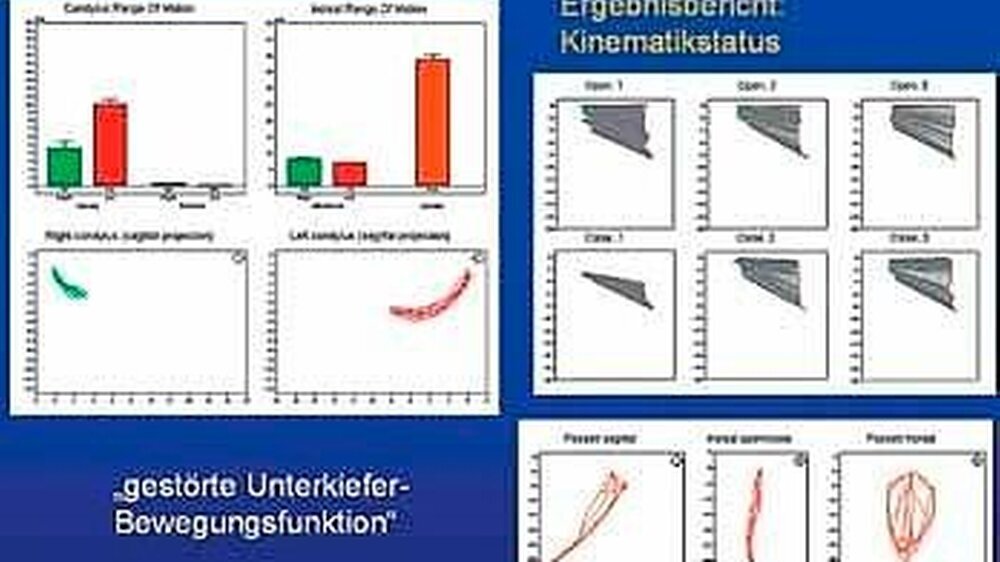 Abbildung 1: Auswertung der instrumentellen Funktionsanalyse (hier: elektronische Bewegungsaufzeichnung) bei pathologisch limitierter Unterkieferbewegung (Abbildung: PD Dr. Alfons Hugger)