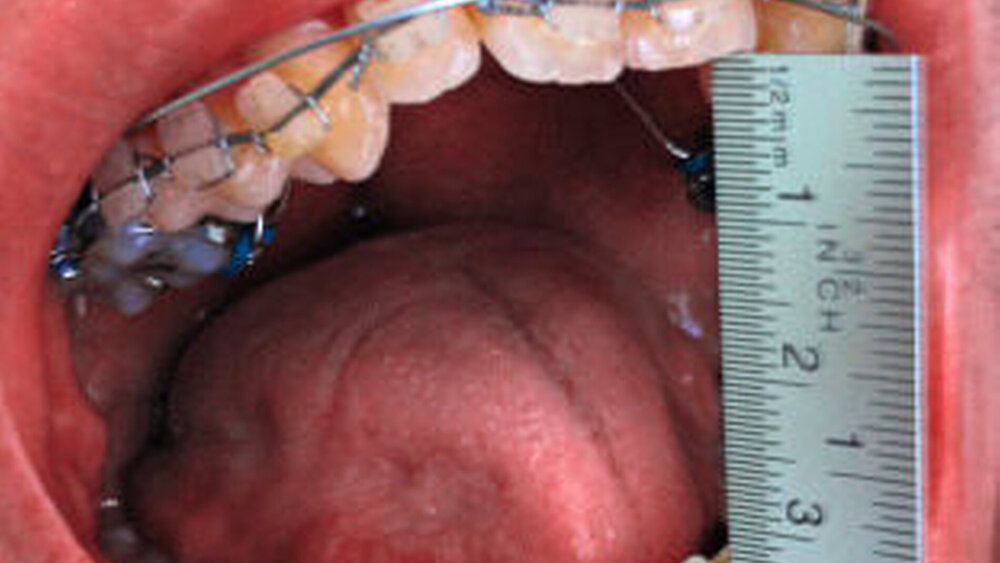 Abbildung 7: Klinisches Bild der maximalen Mundöffnung von SKD 29 mm |