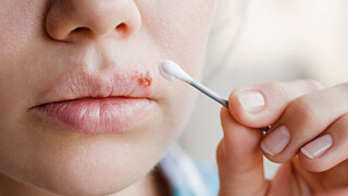 Herpes-Mittel im Test Halten sie, was sie versprechen?
