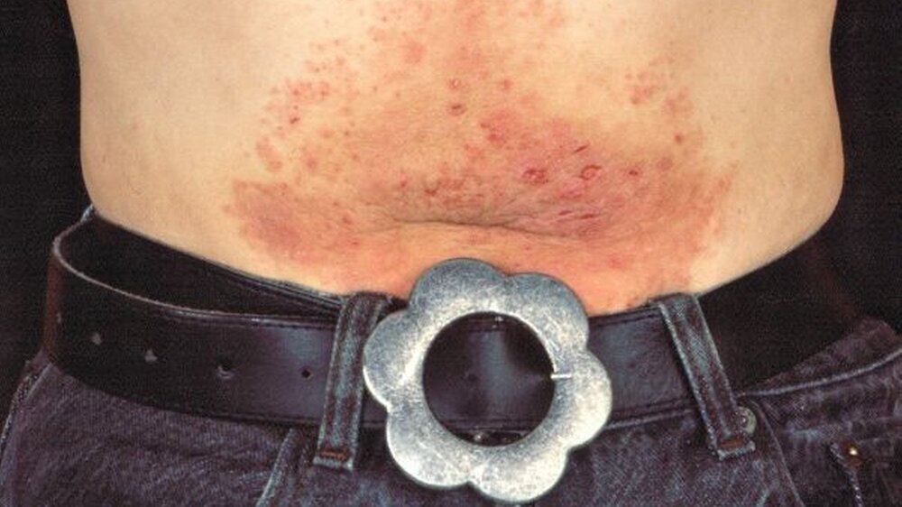 Besonders an Stellen, an denen das nickelhaltige Metall mit der Haut Kontakt hat, treten die Hautirritationen auf. Schweiß verstärkt das Erscheinungsbild dann noch erheblich.