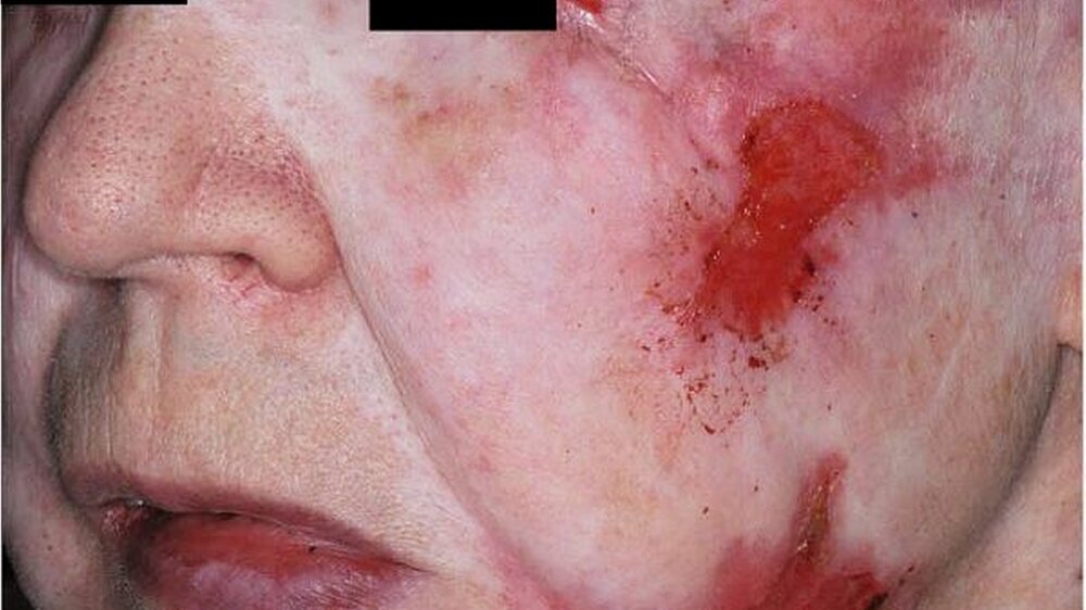 Abbildung 1:\r\nklinische Aspekt der Patientin (a) mit multiplen Excoriationen: Nach langzeitiger\r\nTraumatisierung ist es zu einer massiven Verziehung des Lides gekommen\r\n(Detail in b).