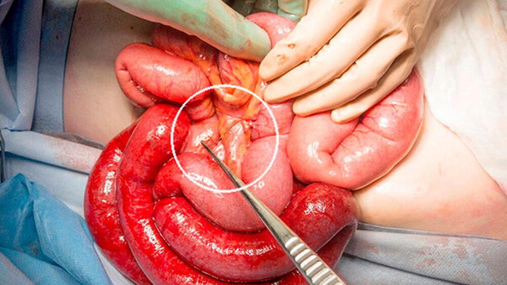 Abbildung 2: Intraoperative Fotografie des kieferorthopädischen Drahts, eingebettet in das Dünndarm-Mesenterium nach Freisetzung des ischämischen Darms.