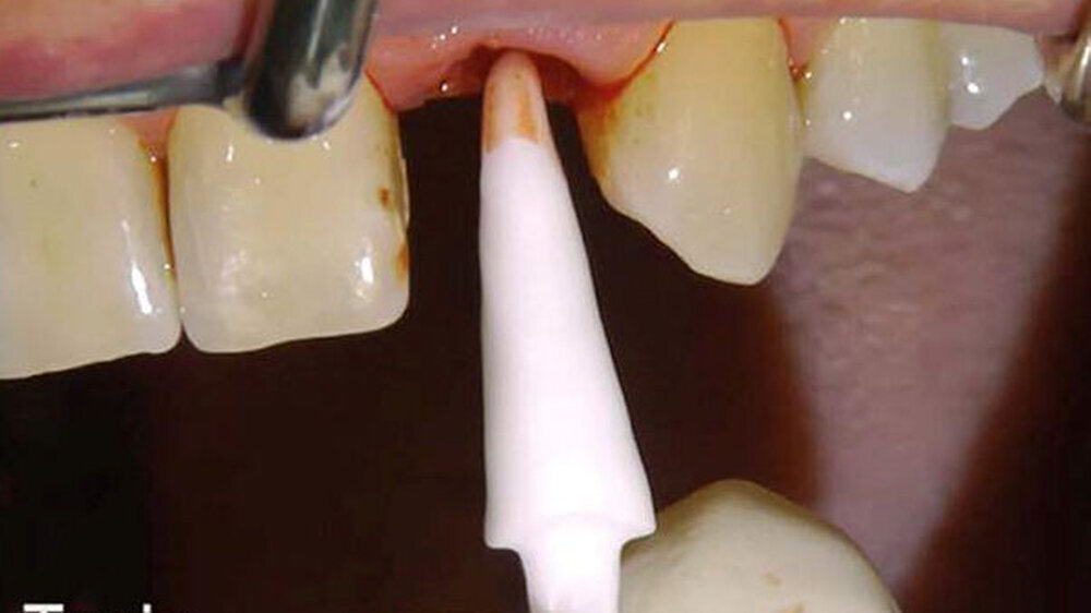 Ein Implantat-Analog aus ZrO2-Keramik wurde als Try-in gefräst. Dadurch können Sitz und Passung des definitiven Implantats in der Alveole vorab geprüft werden.