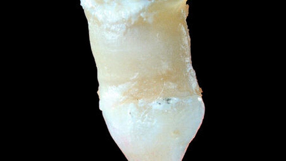 Abbildungen 2a und 2b: Oberkiefer-Zapfenzahn mit Invagination: Im Röntgenbild sind die Schmelzauskleidung der Invagination und eine periapikale Aufhellung gut erkennbar. Die Invagination führte zu einer abnormen Wurzelform. |