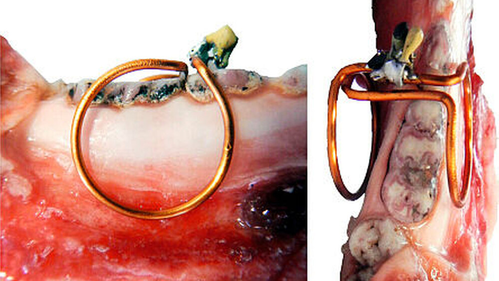 Darstellung der intraoralen Spule auf einem porcinen Unterkieferpräparat ex vivo |