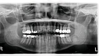 Abbildung 1: Panoramaschichtaufnahme (OPG) mit intraossärer Raumforderung im Bereich des linken Kieferwinkels: Es fällt ein zirkulärer Randsaum mit sklerotischer Begrenzung zur Mandibula auf.