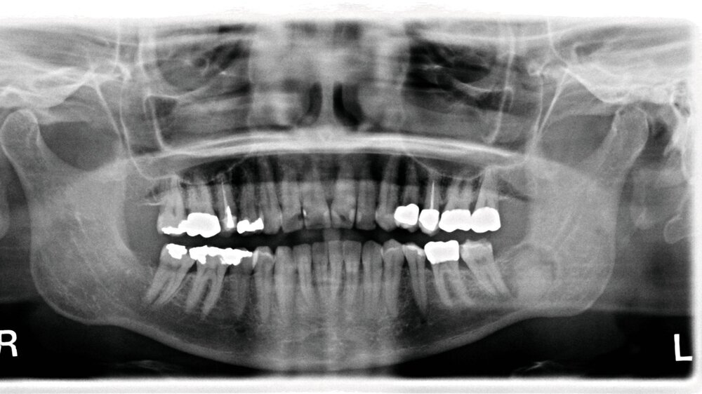 Abbildung 1: Panoramaschichtaufnahme (OPG) mit intraossärer Raumforderung im Bereich des linken Kieferwinkels: Es fällt ein zirkulärer Randsaum mit sklerotischer Begrenzung zur Mandibula auf.