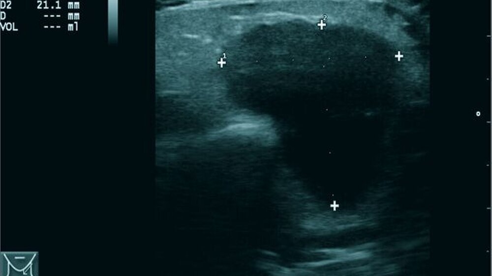 Abbildung 1: Sonographischer Befund des kaudalen Pols der linken Glandula parotidea mit Anschnitt des Kieferwinkels. Der Befund selbst ist relativ glatt begrenzt, zieht hinter den aufsteigenden Unterkieferast und hat eine Größe von über 2 cm in seiner