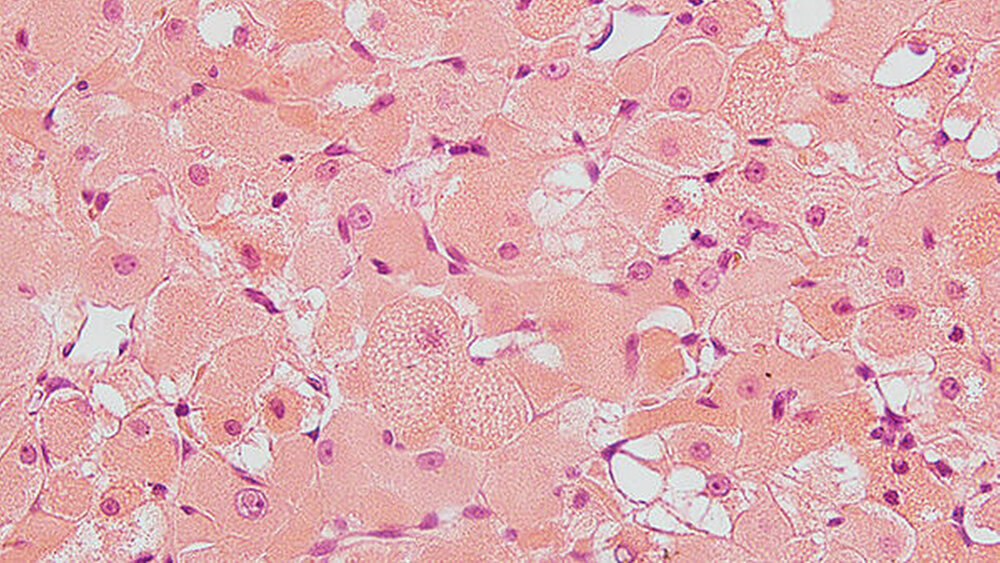 Abbildung 3: Histologisches Präparat (HE, Vergrößerung x400): Es zeigt sich eine Proliferation von großleibigen Zellen mit eosinophilem Zytoplasma, das angedeutet streifig ist. Ebenso finden sich sogenannte Spider-Zellen. |