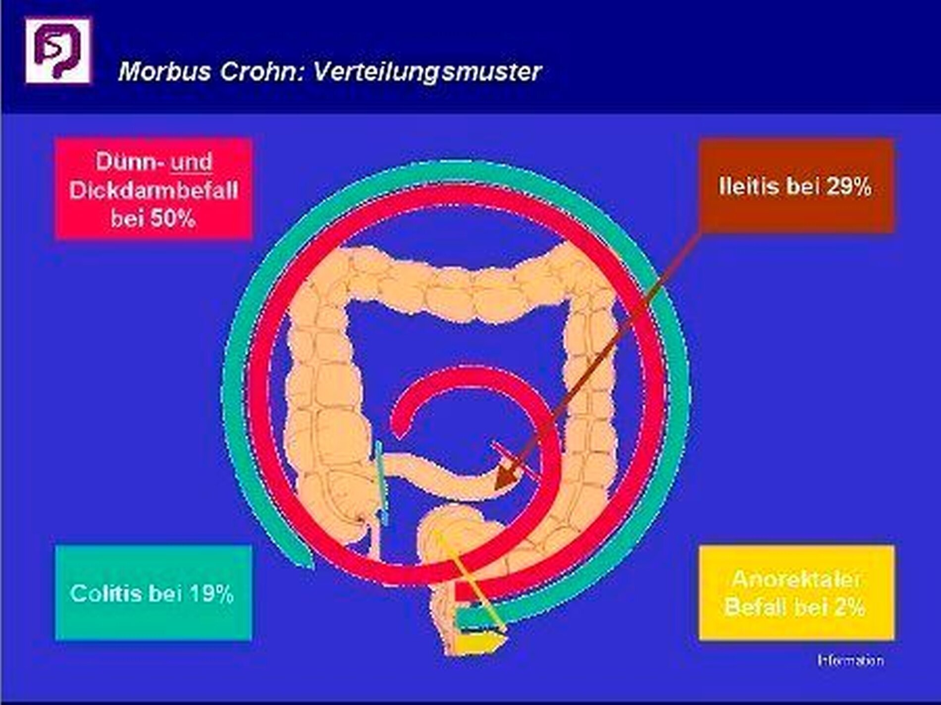 Der Morbus Crohn