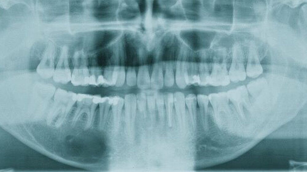 Abbildung 1: präoperatives Orthopantomogramm: zystische Veränderung im Bereich der Zähne 45-46, Nebenbefundlich zystische halbkugelige Veränderung im Bereich des rechten Sinus maxillaris