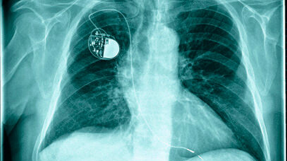 Abbildung 1: Im Röntgen-Thorax der Lunge posterior anterior gibt es keinerlei Hinweis auf das Vorliegen einer pulmonalen Raumforderung bei Vorliegen eines Zwerchfellhochstands und Verschiebung des Mediastinums nach rechts bei Zustand nach Lobektomie des
