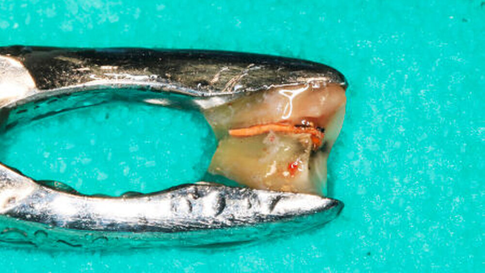 Abbildung 6a: nicht-erhaltungsfähiger Zahn mit Wurzelkanalfüllung |