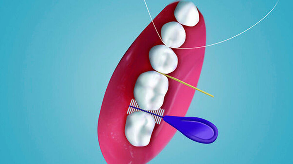 Interdentalbürsten wirken bei interproximalen Blutungen vorbeugend.