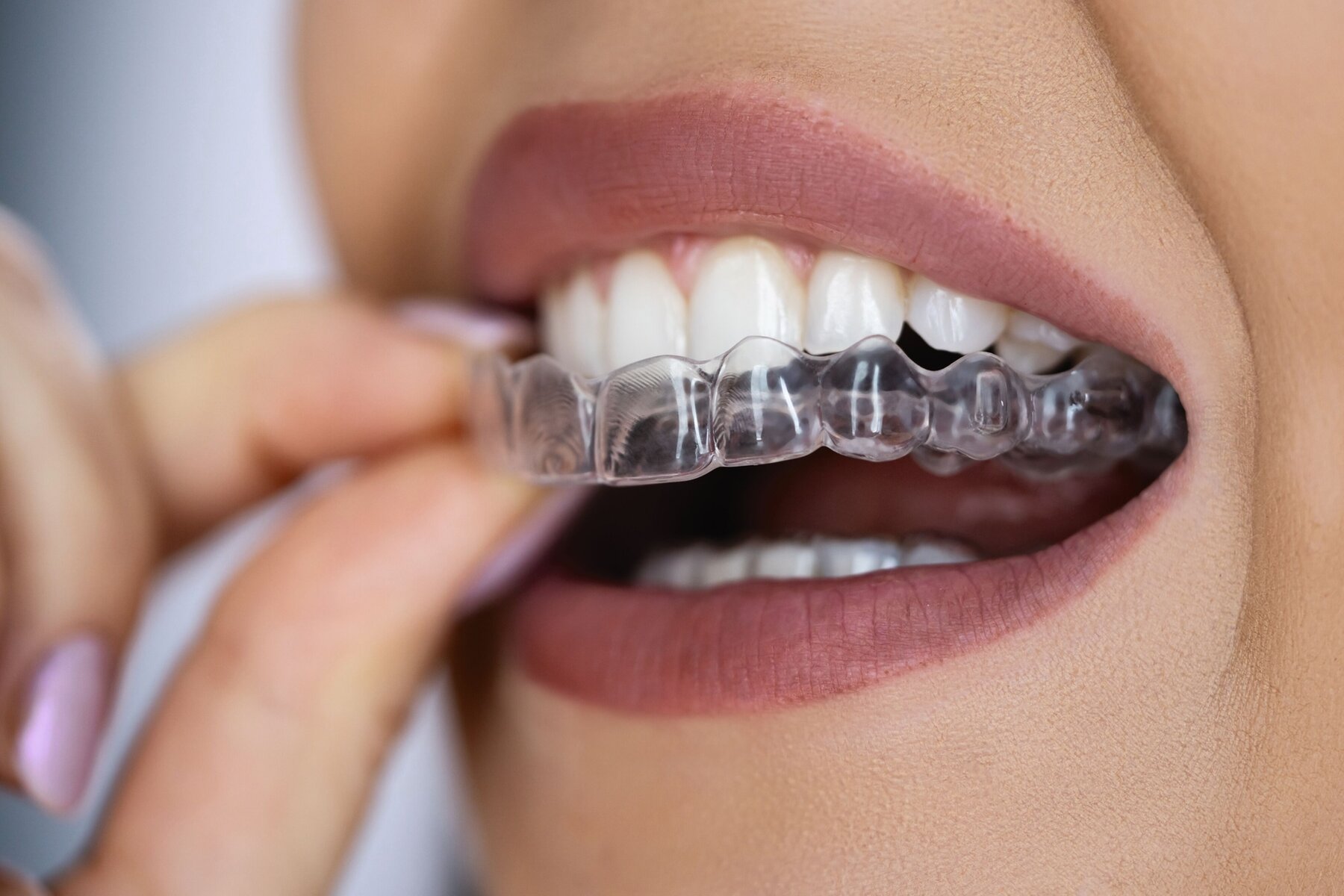 Aligner