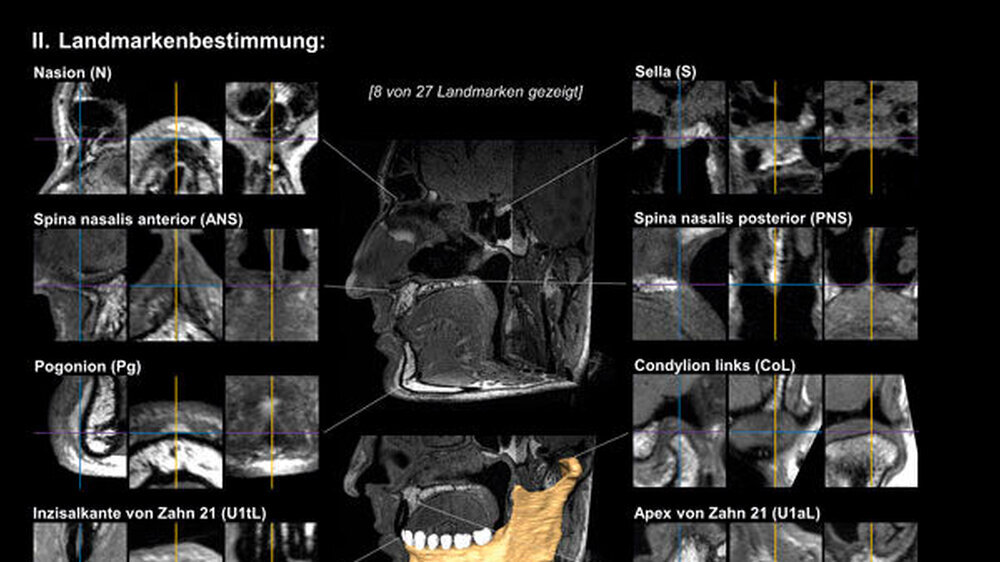 Abbildung 1: Bestimmung von skelettalen und dentalen Landmarken zur MRT-basierten 3-D-Kephalometrie: In der aktuellen 3-D-Kephalometrie-Studie wurde der Kopf jedes Probanden in fünf verschiedenen Rotationsrichtungen im MRT untersucht, um zu zeigen, dass