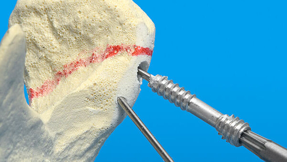 Abbildung 2: Ein zweiter Kirschnerdraht wurde zur Rotationsstabilität platziert, über den oberen Draht wird die kanülierte Schraube eingebracht.