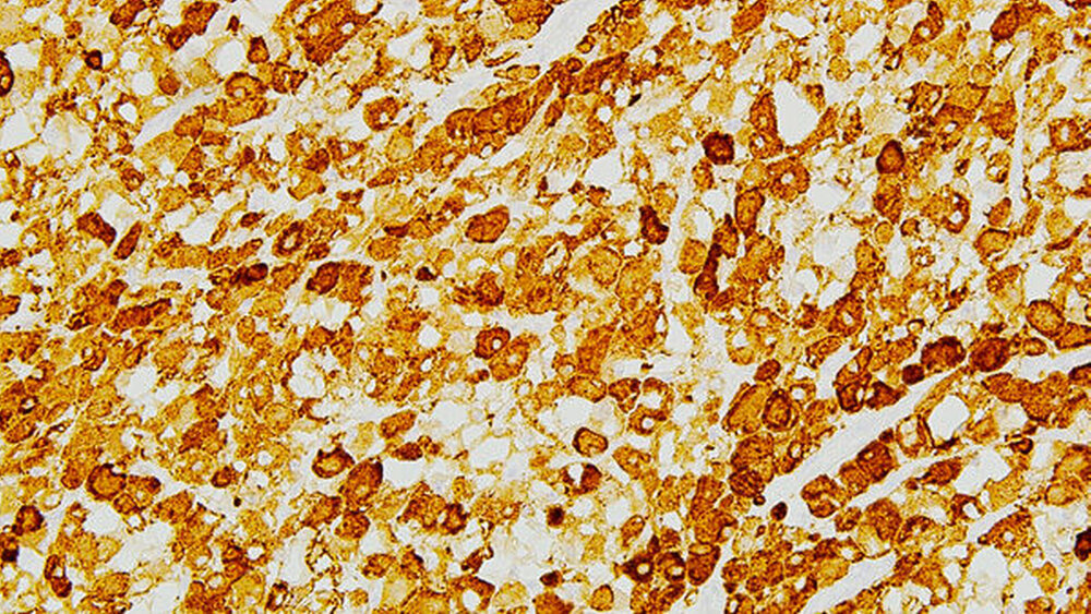 Abbildung 4: Histologisches Präparat (Immunhistochemische Färbung für Desmin, Vergrößerung x200): Die Zellen zeigen eine kräftige zytoplasmatische Färbung für Desmin, ein Intermediärfilament, das sowohl in der Skelett- als auch in der glatten Muskulatur vorkommt. |