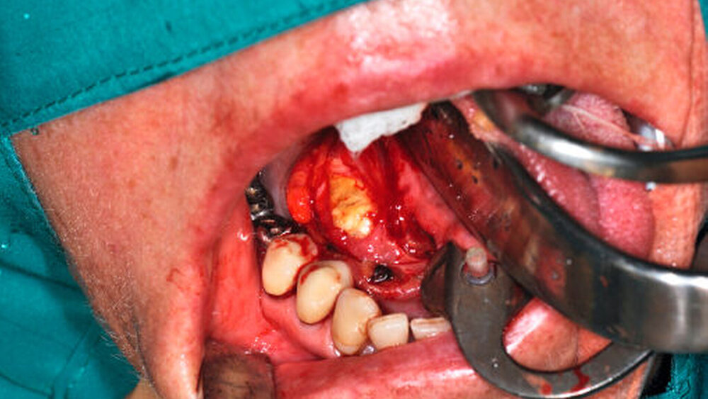 Abbildung 4:  Klinisches Bild der  intraoperativen Situation mit eröffnetem Ausführungsgang (Warthon-Gang) der Gl. submandibularis rechts: Der Speichelstein wurde mit dem Zeigefinger ausmassiert. |