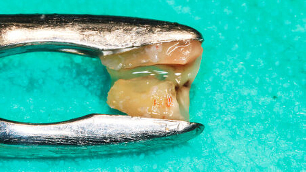 Abbildung 6b: Das Wurzelfüllmaterial lässt sich sehr einfach nach lateraler Perforation des Kanals entfernen. |