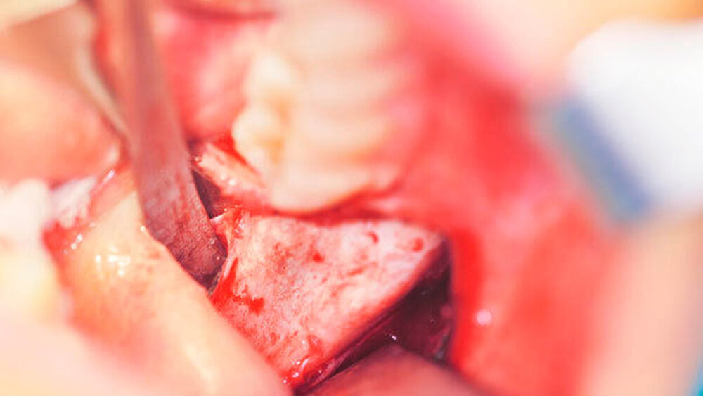 Abbildung 3: Intraoperative Situation nach Darstellung des retromolar-krestalen Knochens. Eine zystische Struktur lässt sich durchscheinend bereits erahnen. |