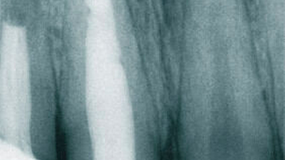 Kontrollaufnahme nach erfolgter thermoplastischer Kanalobstruktion |