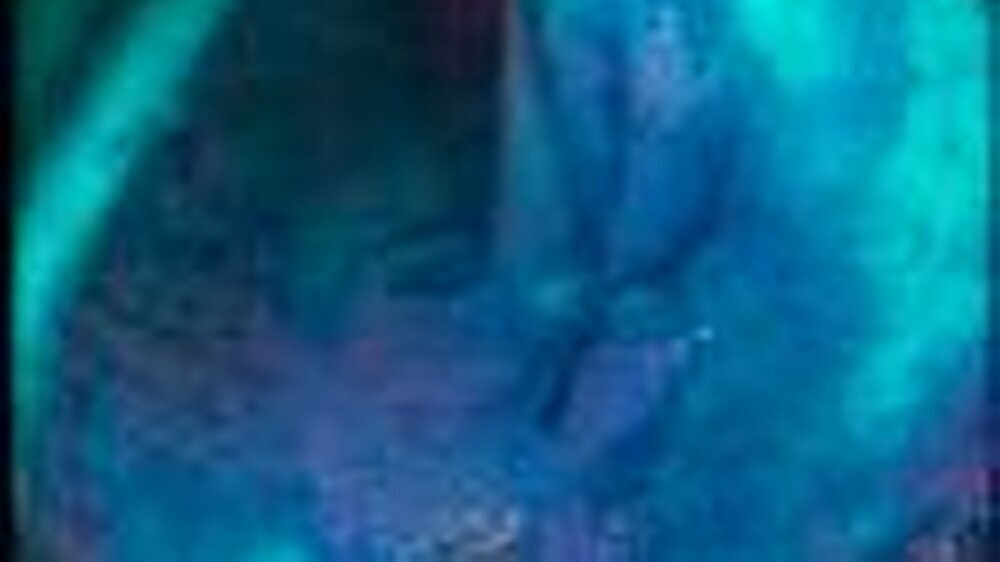 Darstellung eines noch gutartig entarteten Darmpolypen: Oben (in rot) das normale endoskopische Bild, in der Mitte nach Anfärbung mit Indigokarmin und im unteren Bild nach Zoom in der Optik das eindeutige Bild.